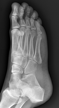 Foot Xray